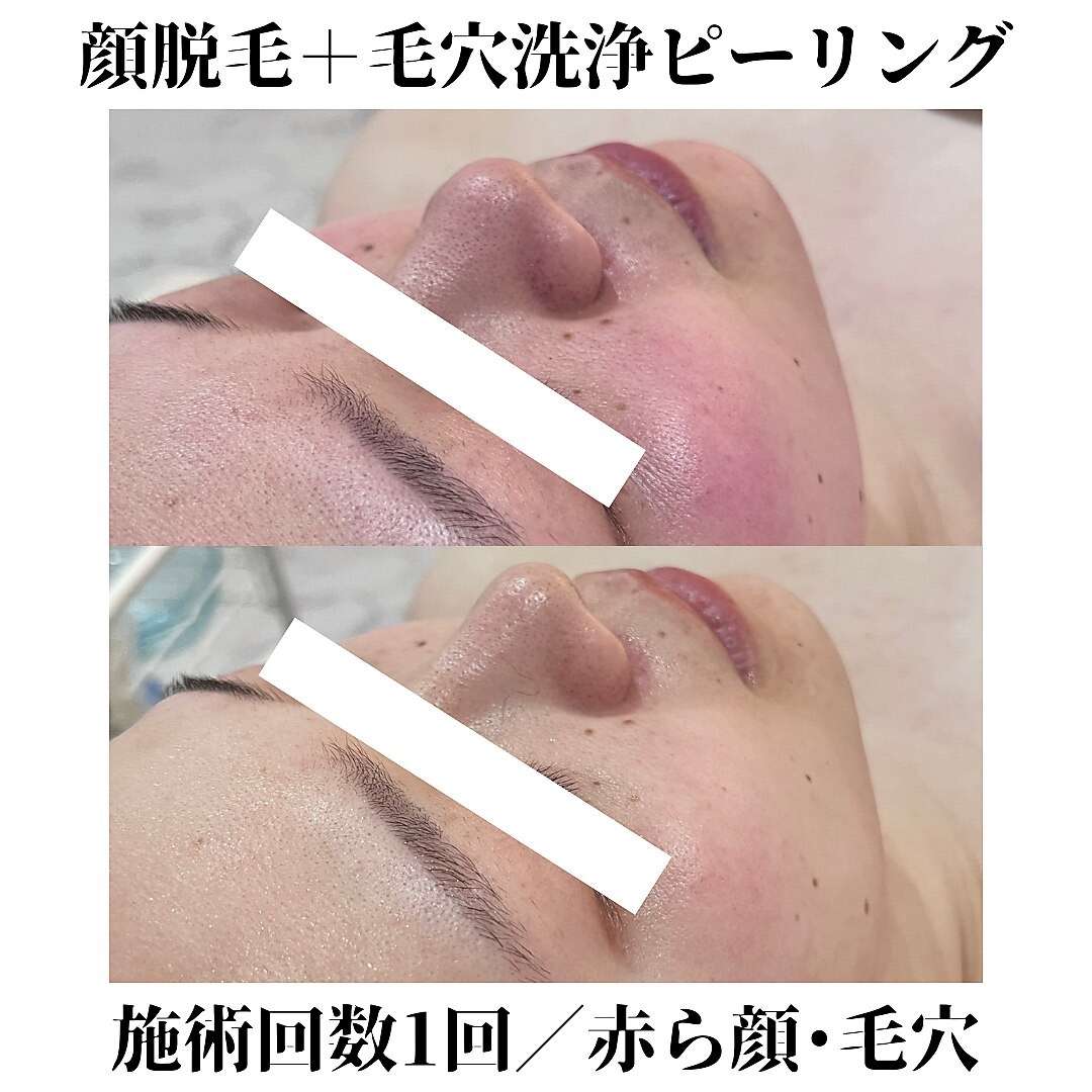 ハイドラ毛穴洗浄 顔脱毛 | ギャラリー | 北九州でエステならTOTAL
