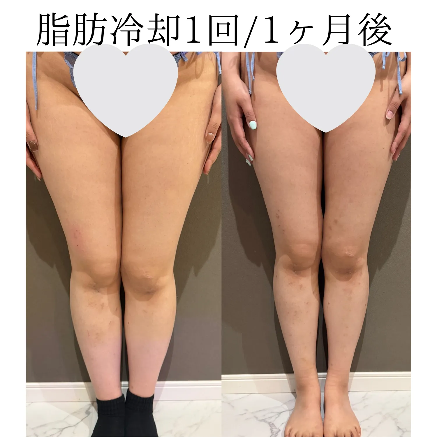脂肪冷却太もも/2カップ1回