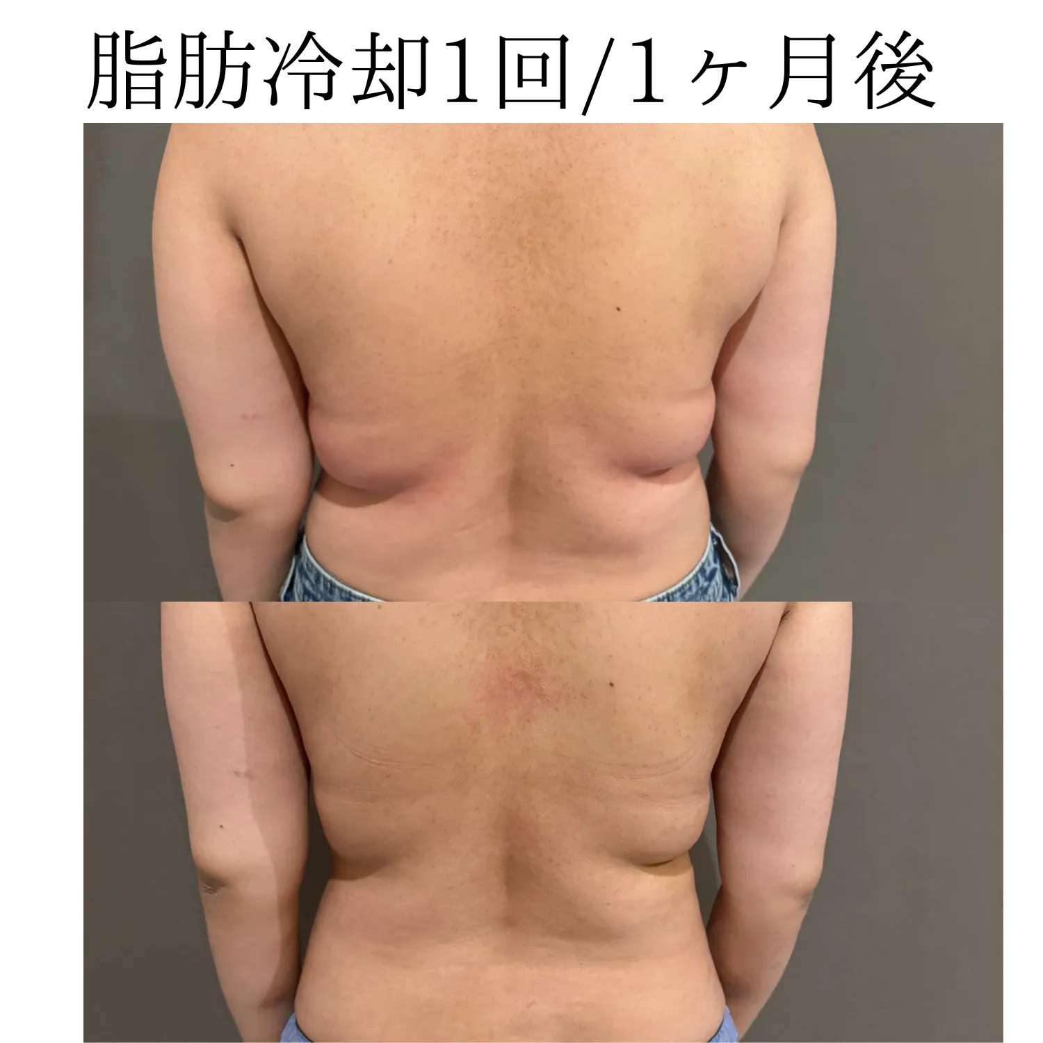 脂肪冷却背中/1回